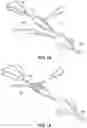 Fig. 15 - STYLET WITH IMPROVED THREADABILITY