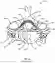 Fig. 02 - MEDICAL DELIVERY DEVICE AND METHOD FOR DELIVERING THERAPEUTIC AGENTS DIRECTLY INTO THE ANNULUS FIBROSUS OF AN INTERVERTEBRAL DISC