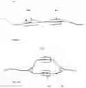 Fig. 05 - System and Method for Controlling CSF Flow and Managing Intracranial Pressure