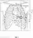 Fig. 02 - Implantable medical systems and methods for intercostal lead implant