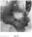 Fig. 21 - STABILIZED AND NO2-INHIBITED NITRIC OXIDE GENERATING GELS FOR INHALED NITRIC OXIDE THERAPY