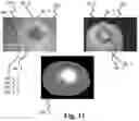 Fig. 10 - Ostomy condition classification with masking, devices and related methods
