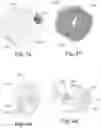 Fig. 05 - Pruner scrubber rotor assembly