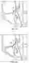 Fig. 14 - SYSTEMS, INSTRUMENTS AND METHODS FOR TREATING A SUBJECT