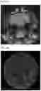 Fig. 03 - QUANTITATIVE MEASUREMENT OF THE PERIVASCULAR SPACE FOR CNS AND BRAIN DISORDERS