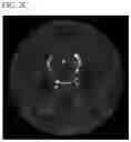 Fig. 04 - QUANTITATIVE MEASUREMENT OF THE PERIVASCULAR SPACE FOR CNS AND BRAIN DISORDERS