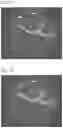 Fig. 06 - QUANTITATIVE MEASUREMENT OF THE PERIVASCULAR SPACE FOR CNS AND BRAIN DISORDERS