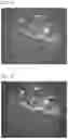 Fig. 07 - QUANTITATIVE MEASUREMENT OF THE PERIVASCULAR SPACE FOR CNS AND BRAIN DISORDERS