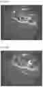 Fig. 08 - QUANTITATIVE MEASUREMENT OF THE PERIVASCULAR SPACE FOR CNS AND BRAIN DISORDERS