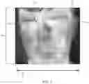 Fig. 06 - THERMAL IMAGING TEMPERATURE MEASUREMENT OF INNER CANTHUS SYSTEMS AND METHODS