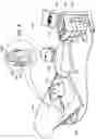 Fig. 11 - GUIDING SHEATH WITH DISTAL TIP LOCATOR