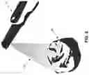 Fig. 03 - Metal artifacts reduction in cone beam reconstruction