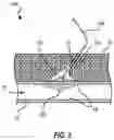 Fig. 13 - VESSEL CLOSURE DEVICE WITH IMPROVED SAFETY AND TRACT HEMOSTASIS