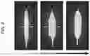 Fig. 04 - BIOADHESIVE MATERIALS AND MINIMALLY INVASIVE METHODS FOR ADHERING TISSUES WITH BIOADHESIVE MATERIALS