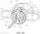 Fig. 08 - Flexible anchor delivery system
