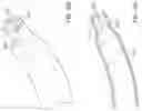 Fig. 29 - Flexible anchor delivery system