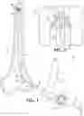 Fig. 02 - Orthopedic reamer with expandable cutting head