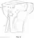 Fig. 08 - Orthopedic drill bit with swiveling head