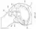 Fig. 41 - Guides and instruments for improving accuracy of glenoid implant placement