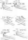 Fig. 12 - Apparatus and methods for disrupting inter vertebral disc tissue