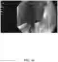 Fig. 11 - SYSTEMS AND METHODS FOR REMOVING MATERIALS FROM THE PANCREAS USING AN ENDOSCOPIC SURGICAL TOOL