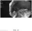Fig. 12 - SYSTEMS AND METHODS FOR REMOVING MATERIALS FROM THE PANCREAS USING AN ENDOSCOPIC SURGICAL TOOL