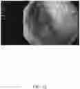 Fig. 13 - SYSTEMS AND METHODS FOR REMOVING MATERIALS FROM THE PANCREAS USING AN ENDOSCOPIC SURGICAL TOOL