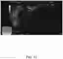 Fig. 15 - SYSTEMS AND METHODS FOR REMOVING MATERIALS FROM THE PANCREAS USING AN ENDOSCOPIC SURGICAL TOOL