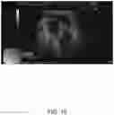 Fig. 19 - SYSTEMS AND METHODS FOR REMOVING MATERIALS FROM THE PANCREAS USING AN ENDOSCOPIC SURGICAL TOOL