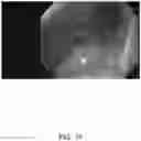 Fig. 20 - SYSTEMS AND METHODS FOR REMOVING MATERIALS FROM THE PANCREAS USING AN ENDOSCOPIC SURGICAL TOOL