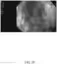 Fig. 21 - SYSTEMS AND METHODS FOR REMOVING MATERIALS FROM THE PANCREAS USING AN ENDOSCOPIC SURGICAL TOOL