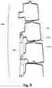 Fig. 10 - Non-invasively adjustable spinal stabilization device