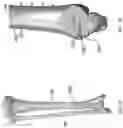 Fig. 13 - DISTAL TIBIAL PLATING SYSTEM