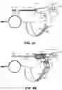 Fig. 03 - SYSTEMS AND METHODS FOR THERAPY OF PELVIC CONDITIONS