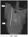 Fig. 40 - APPARATUS AND METHODS FOR USE WITH IMAGE-GUIDED SKELETAL PROCEDURES