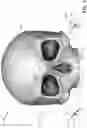 Fig. 02 - Apparatus and a method to verify safe positioning of osteotomy trajectory for zygomatic implant surgery