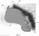 Fig. 03 - MULTIPLE MATERIAL DENTAL APPARATUSES AND TECHNIQUES FOR MAKING THE SAME