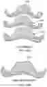Fig. 16 - MULTIPLE MATERIAL DENTAL APPARATUSES AND TECHNIQUES FOR MAKING THE SAME