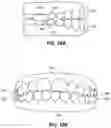 Fig. 25 - MULTIPLE MATERIAL DENTAL APPARATUSES AND TECHNIQUES FOR MAKING THE SAME