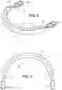 Fig. 05 - LIP ENHANCEMENT DEVICE