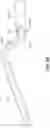 Fig. 13 - SYSTEMS, DEVICES, AND METHODS FOR THE RETRIEVAL OF AN IMPLANT IN THE PROSTATIC URETHRA