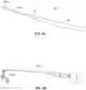 Fig. 29 - SYSTEMS, DEVICES, AND METHODS FOR THE RETRIEVAL OF AN IMPLANT IN THE PROSTATIC URETHRA