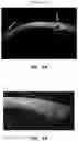 Fig. 09 - METHODS AND MATERIALS FOR MODIFYING CORNEAL SHAPE