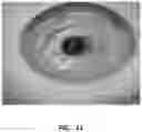 Fig. 16 - METHODS AND MATERIALS FOR MODIFYING CORNEAL SHAPE