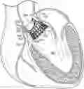 Fig. 01 - COLLAPSIBLE-EXPANDABLE HEART VALVES