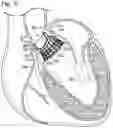 Fig. 05 - COLLAPSIBLE-EXPANDABLE HEART VALVES