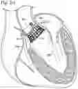 Fig. 11 - COLLAPSIBLE-EXPANDABLE HEART VALVES