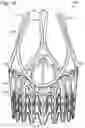 Fig. 15 - COLLAPSIBLE-EXPANDABLE HEART VALVES