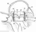 Fig. 01 - REPLACEMENT HEART VALVE SYSTEMS AND METHODS