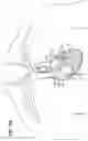 Fig. 17 - REPLACEMENT HEART VALVE SYSTEMS AND METHODS